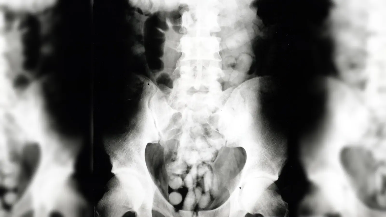 Bodypacker nutzen ihren Körper als Drogenversteck - ein riskantes Spiel. (Foto: Zoll)